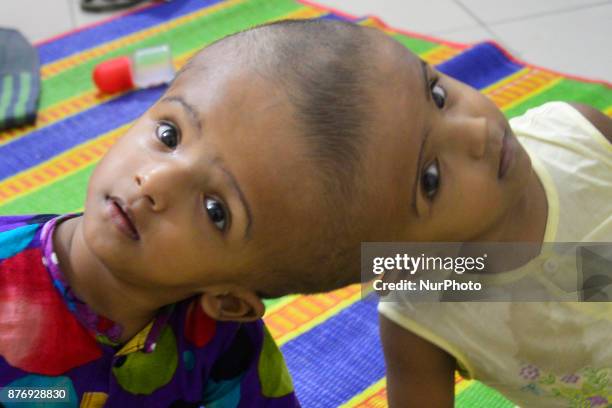 Conjoined twin girls Rabeya Islam and Rokeya Islam play at a Dhaka Medical Collage Hospital in Dhaka, Bangladesh on November 21, 2017. Taslima...