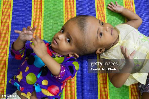 Conjoined twin girls Rabeya Islam and Rokeya Islam play at a Dhaka Medical Collage Hospital in Dhaka, Bangladesh on November 21, 2017. Taslima...