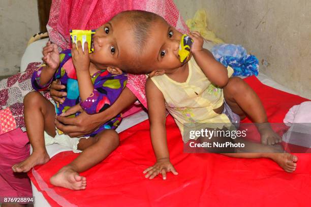 Conjoined twin girls Rabeya Islam and Rokeya Islam play at a Dhaka Medical Collage Hospital in Dhaka, Bangladesh on November 21, 2017. Taslima...