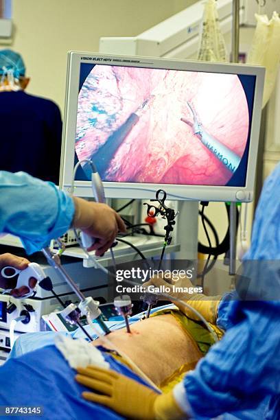 May 15: South African surgeon, professor Heine van der Walt performs a live thoracoscopic extended transthoracic esophagus myotomy plus a...