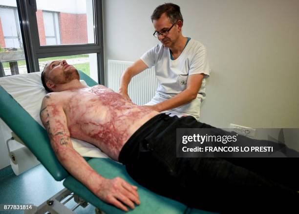 Franck Dufourmantelle, 33-year-old who had suffered burns over 95 percent of his body and was saved by a skin transplant from his identical twin...