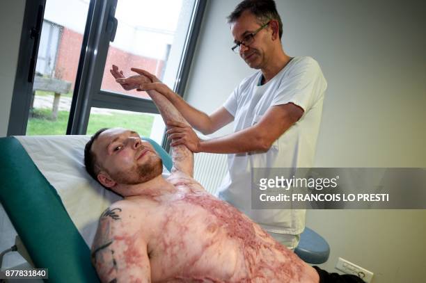 Franck Dufourmantelle, 33-year-old who had suffered burns over 95 percent of his body and was saved by a skin transplant from his identical twin...
