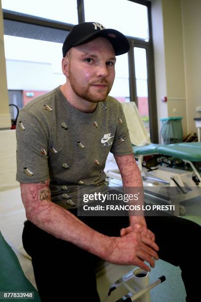 Franck Dufourmantelle, 33-year-old who had suffered burns over 95 percent of his body and was saved by a skin transplant from his identical twin...