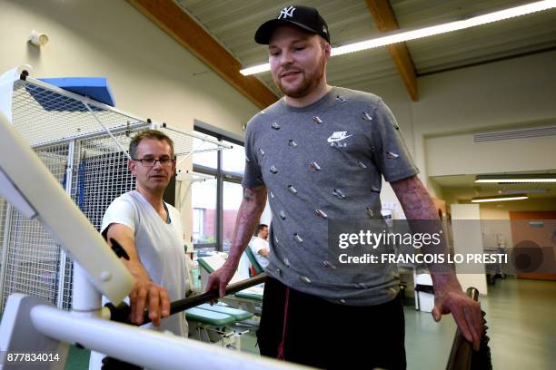 Franck Dufourmantelle, 33-year-old who had suffered burns over 95 percent of his body and was saved by a skin transplant from his identical twin...