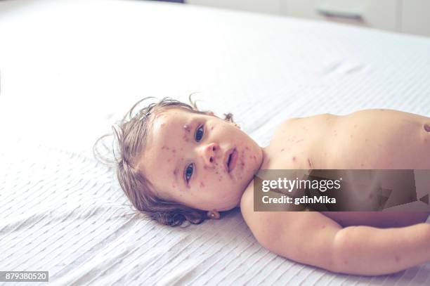 poco chica con sarampión - sarampion fotografías e imágenes de stock