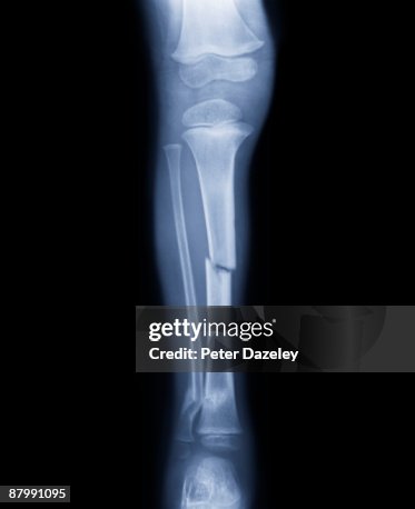 Fracture of human leg. Fracture of human leg.