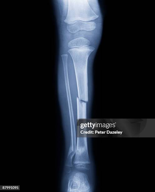 fracture of human leg. - imagen de rayos x fotografías e imágenes de stock