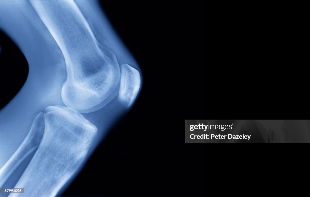 X-ray of human knee,