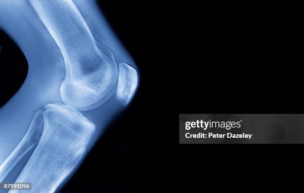 x-ray of human knee, - arrodillarse fotografías e imágenes de stock