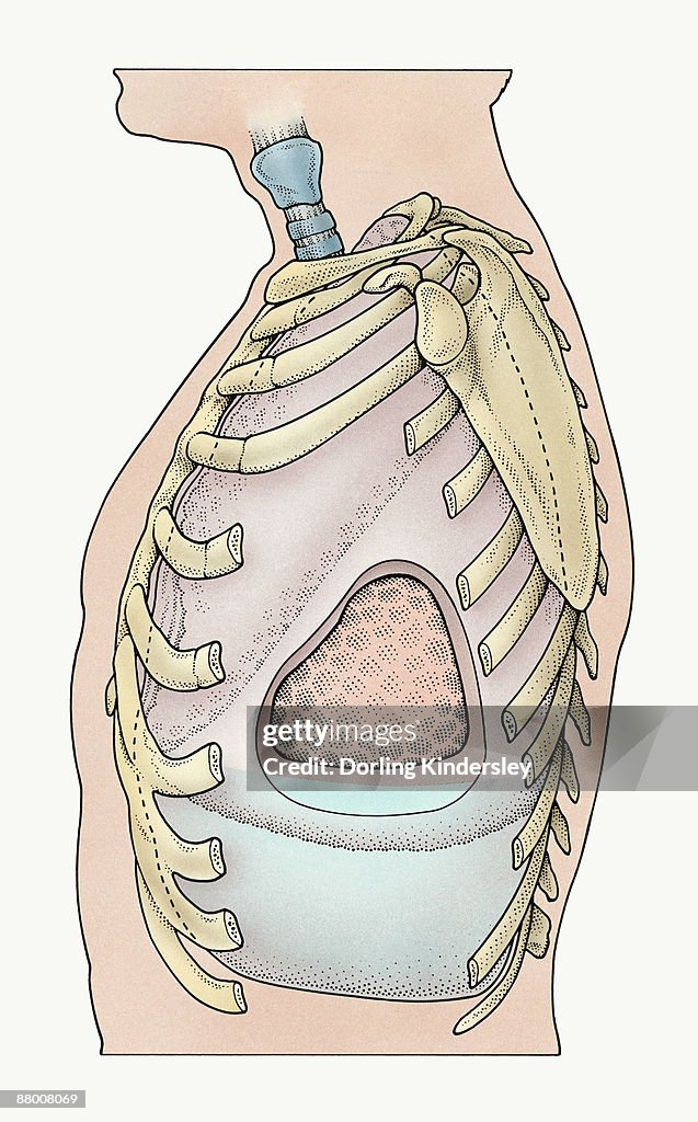 Cross-section through human lung showing inflammation of pleural membranes (pleurisy)