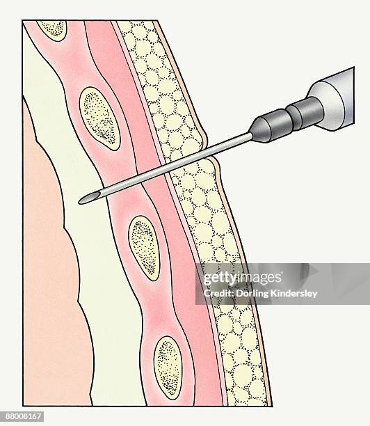 syringe entering pleural membranes around human lung to extract sample - pleural membrane stock illustrations