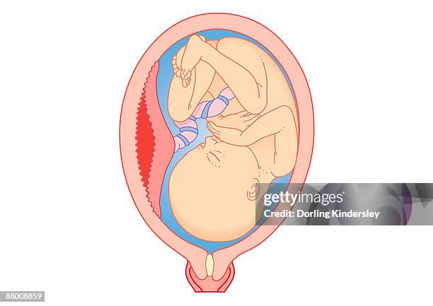 cross section digital illustration showing abruption where placental lining has separated from uterus of mother - unknown gender stock illustrations