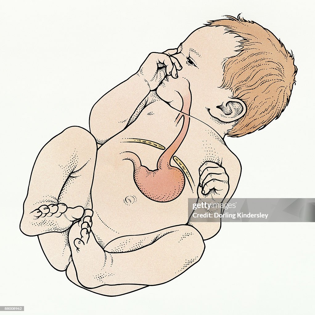 Digital illustration of baby showing Hiatal hernia of upper part of stomach