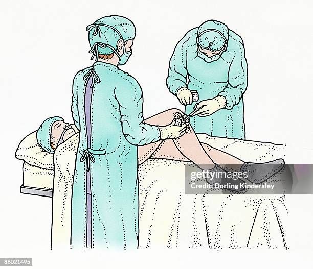 illustration showing surgeon swabbing and removing object from knee of patient lying on operating table  - operating gown stock illustrations