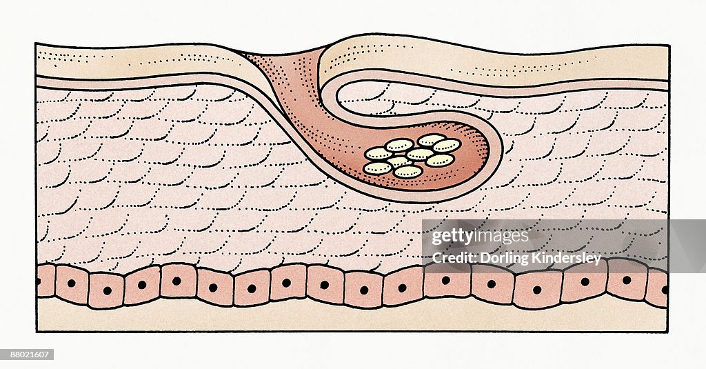 Illustration of subcutaneous scabies eggs