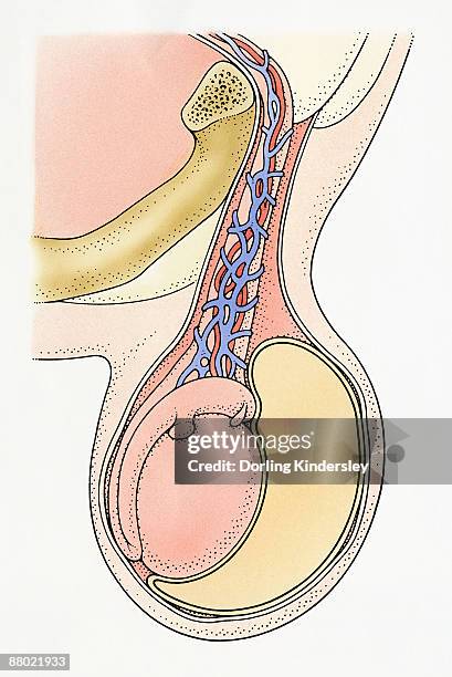 cross section illustration showing infantile hydrocele testis, with clear, amber-coloured fluid from spermatic cord surrounding testicle, resulting in swelling - swollen stock illustrations