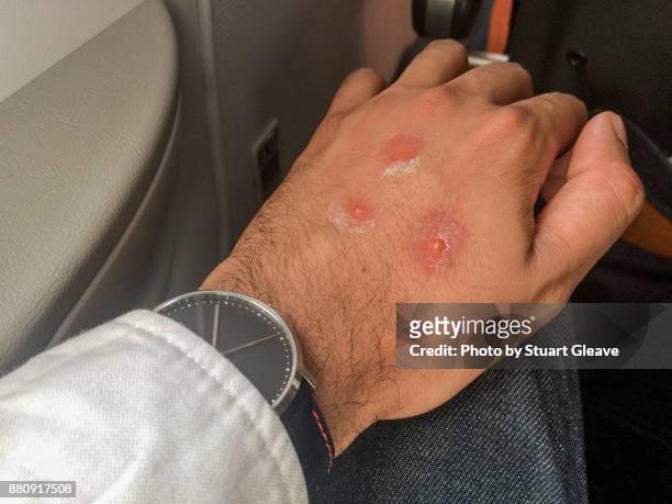 mosquito bites on male hand - insect bites images - fotografias e filmes do acervo