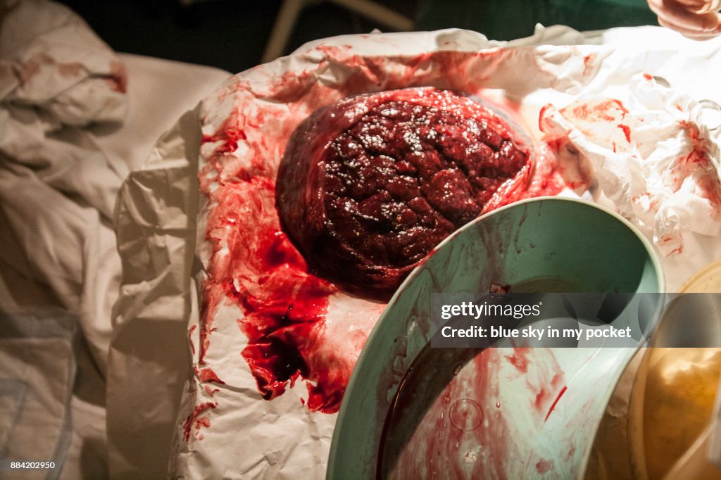 The Placenta from new born baby.