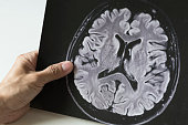 A man holding brain MRI picture