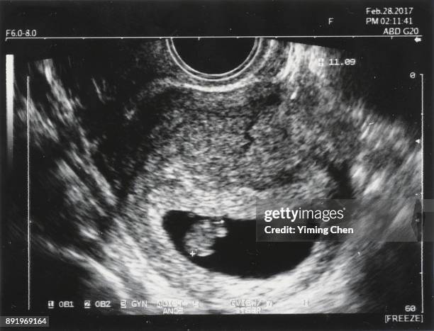 pregnancy ultrasound - fetus stock-fotos und bilder