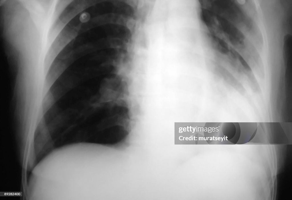 La radiografía pulmonar de pneumonic patien