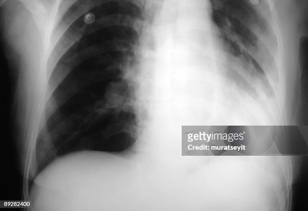 la radiografía pulmonar de pneumonic patien - neumonía fotografías e imágenes de stock
