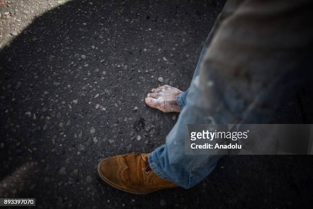 Homeless diabetic man's infected foot is seen in Bogota, Colombia on December 15, 2017. Homeless people, who are called 'CHC', Ciudadanos Habitantes...
