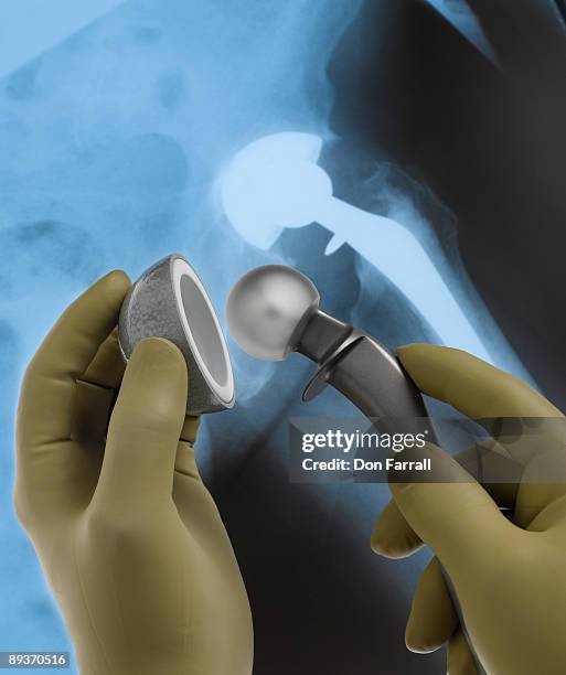 hip replacement - hip replacement stock pictures, royalty-free photos & images