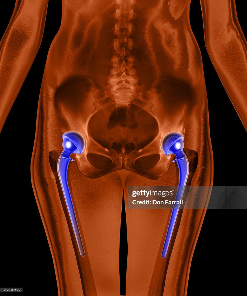 Hip replacement