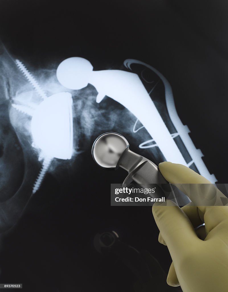 Hip replacement
