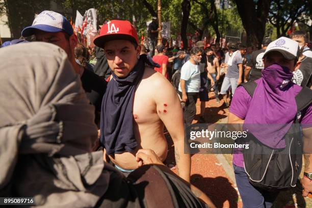 Demonstrator displays rubber bullet wounds during protests against pension reforms in Buenos Aires, Argentina, on Monday, Dec. 18, 2017. Argentina's...