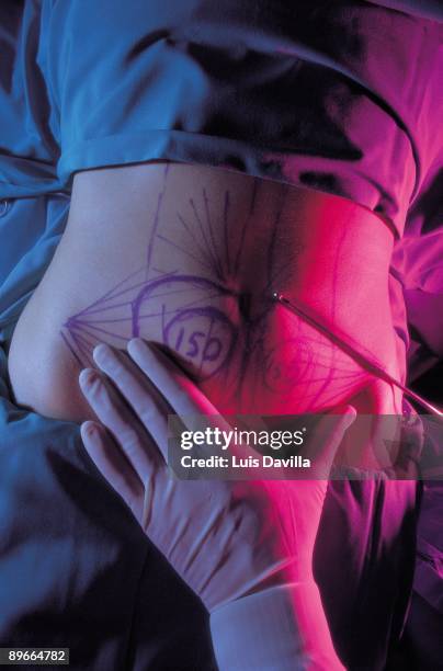 Liposuction Detail of the drawn stomach of a woman in the liposuction sugery