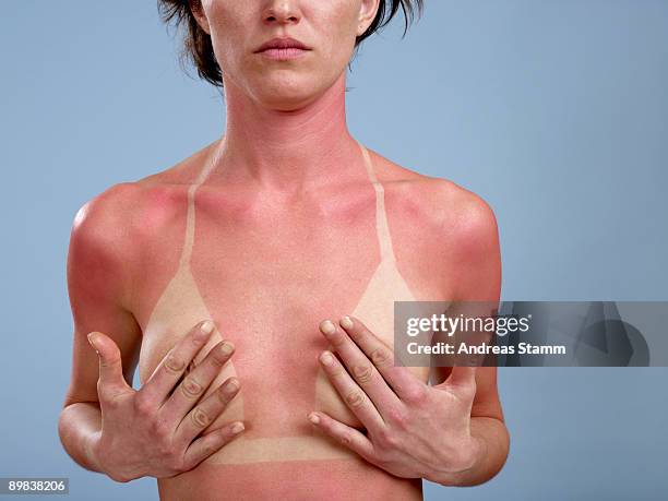 a sunburned woman - marque de bronzage photos et images de collection