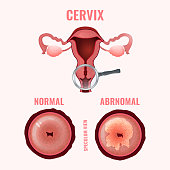 Cervical cancer image