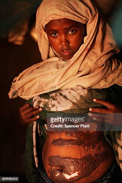 Naib Naema Abde Mohamed displays wounds to her chest and stomach suffered when an Ethiopian shell hit her home in Mogadishu, Somalia August 21, 2009...