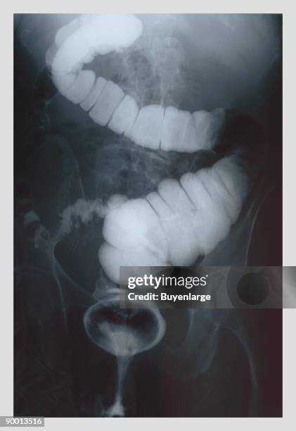 Barium Scan Machine Intestinal Scan Photos and Premium High Res Pictures - Getty Images