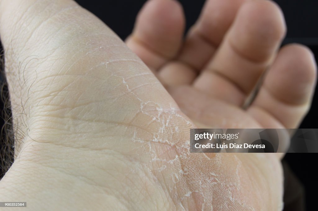 Man with cracked skin