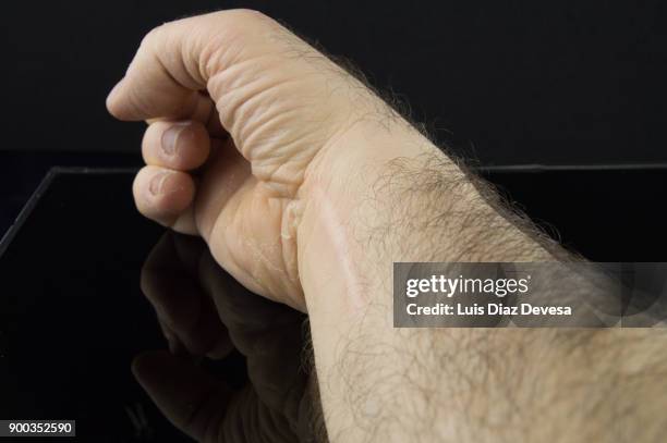 man with cracked skin - agaricus silvaticus stock pictures, royalty-free photos & images