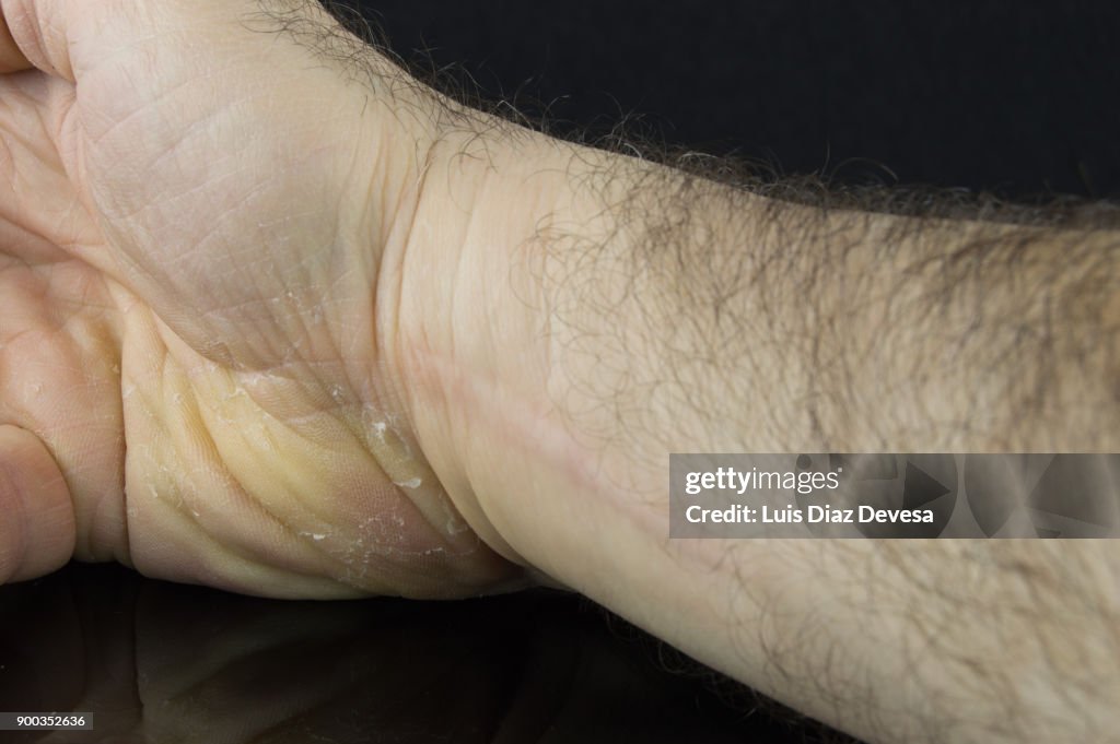 Man with cracked skin