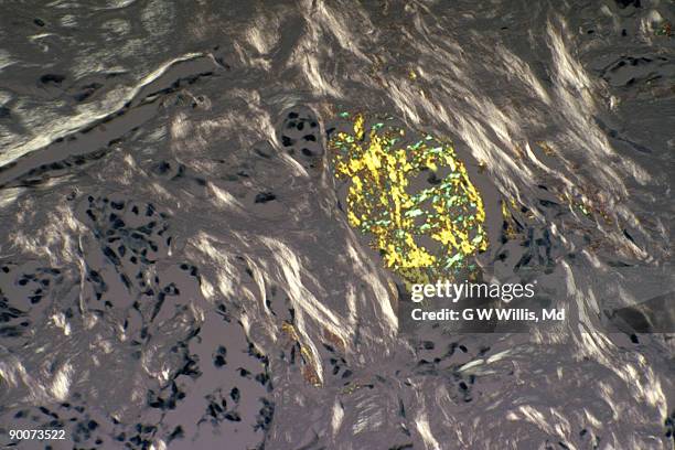 medullary carcinoma of thyroid. - medullary carcinoma stock pictures, royalty-free photos & images