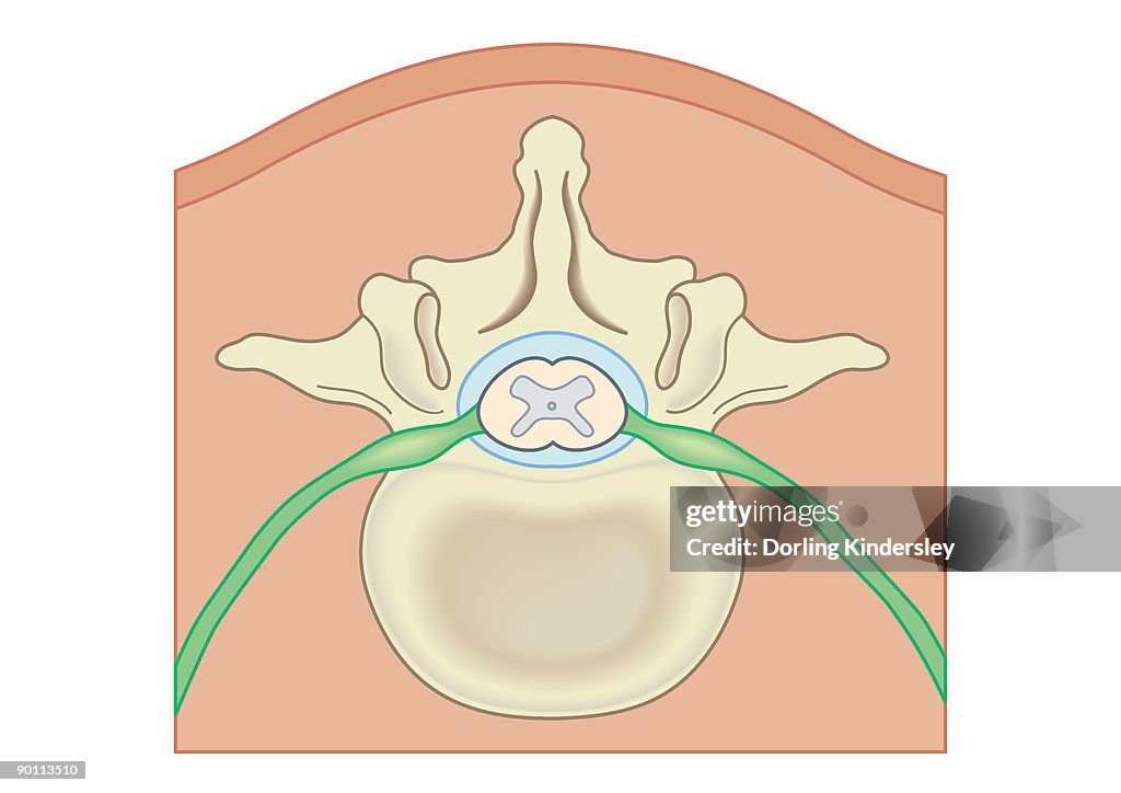 Digital illustration Spina Bifida, Meningocele, where protective covering around spinal cord protrudes through malformed vertebra to form sac filled with cerebrospinal fluid