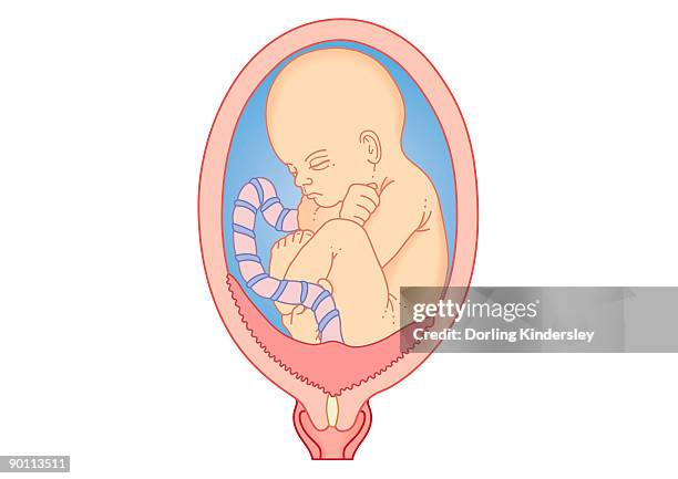 digital illustration showing placenta praevia where the placenta is attached to the uterine wall, entirely covering the cervix - uterine wall stock illustrations