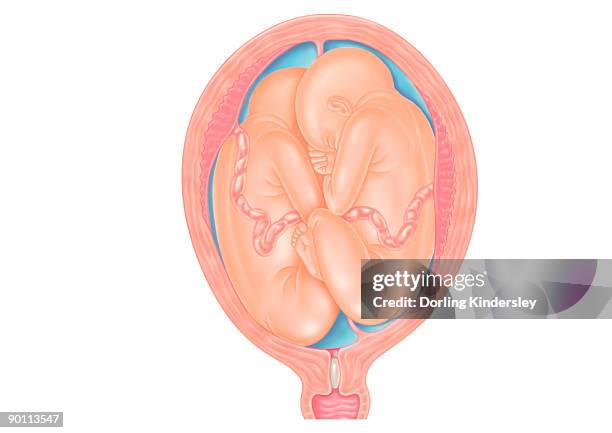 ilustraciones, imágenes clip art, dibujos animados e iconos de stock de cross section digital illustration of twins in breech position with buttocks presented first - cervix