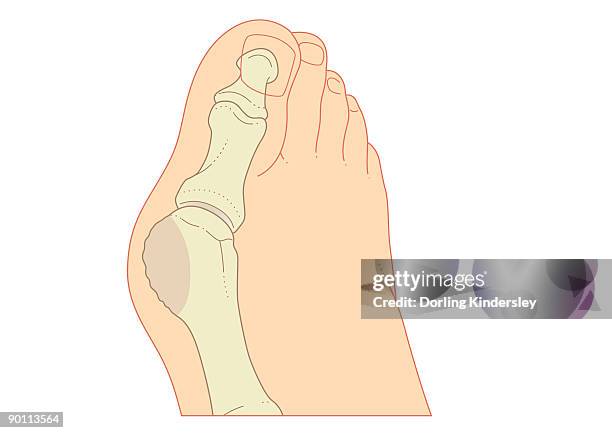 illustrazioni stock, clip art, cartoni animati e icone di tendenza di digital illustration of bunion with enlargement of bone around joint at base of big toe  - hallux valgus