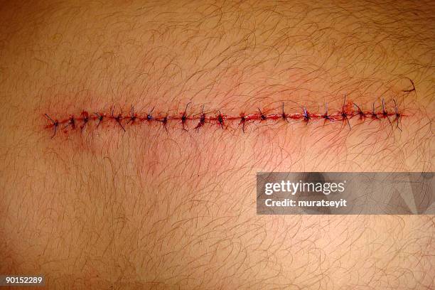 cut by a knife - surgery stitches stock pictures, royalty-free photos & images