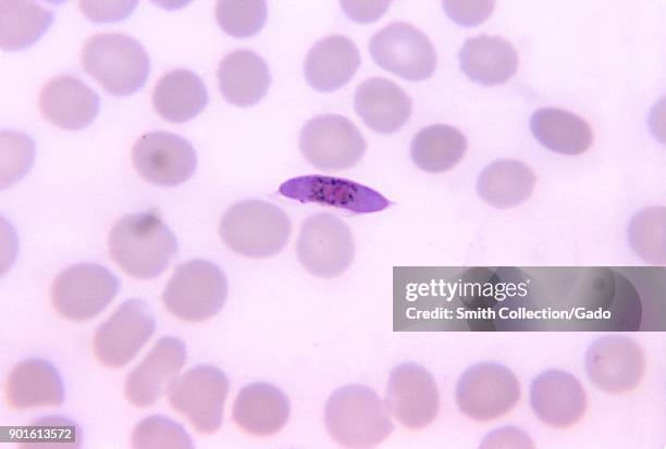 Thin blood smear image of P falciparum macrogametocyte, which can cause kidney failure, 1971. Image courtesy CDC/Dr. Mae Melvin.