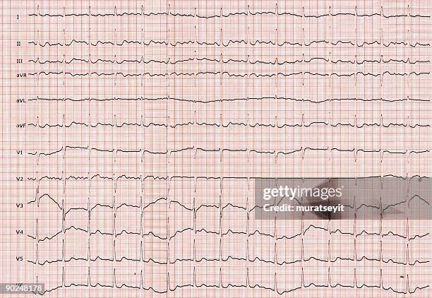 elektrokardiograph - 心臓刺激伝導系 ストックフォトと画像