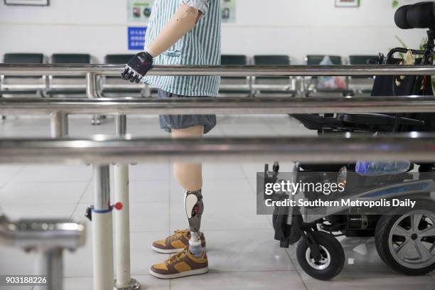 Mr Liu who was burnt 95% of his body practises his new bionic hand at a rehabilitation center on January 3, 2018 in Guangzhou, Guangdong Province of...