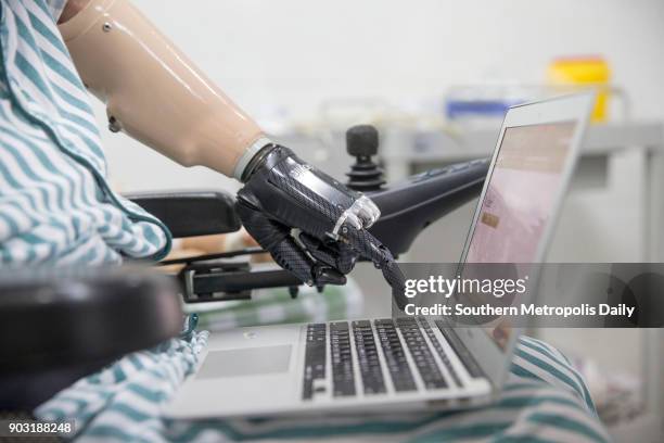 Mr Liu who was burnt 95% of his body taps keyboard with his new bionic hand at a rehabilitation center on January 3, 2018 in Guangzhou, Guangdong...