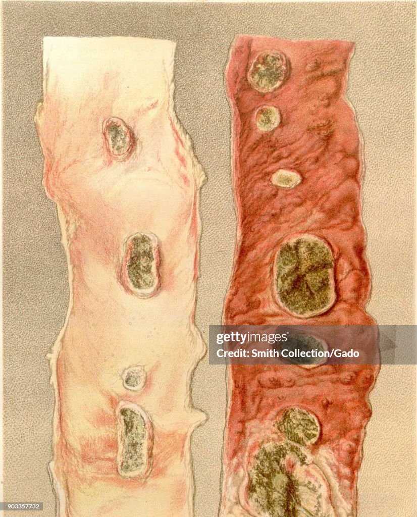 Typhoid Ulcers On Ileum